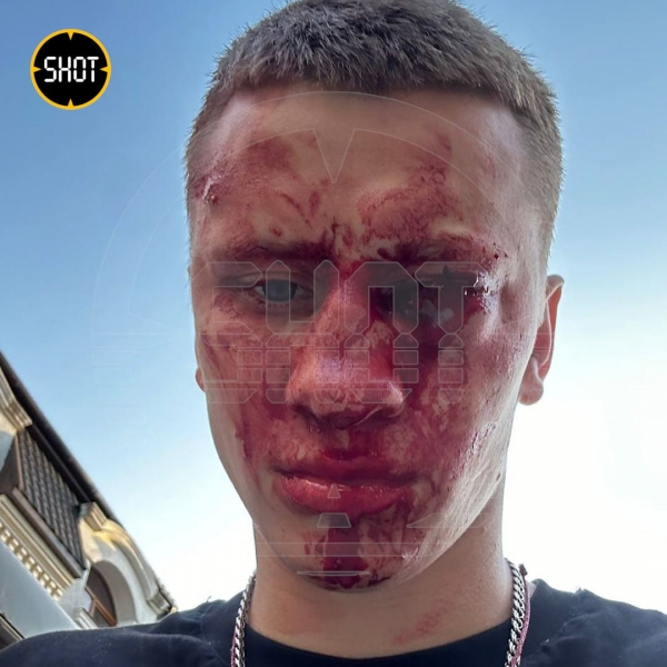 Чемпіону Європи з боксу вибили око у Криму (фото, відео)